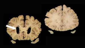 ATN brain scan image
